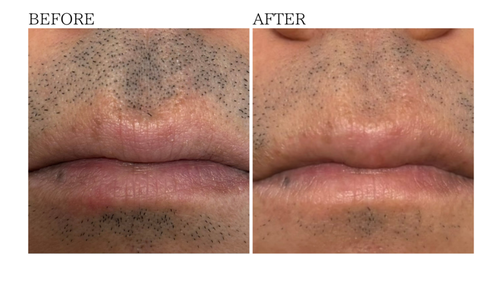 ひげ脱毛BERORE　AFTER